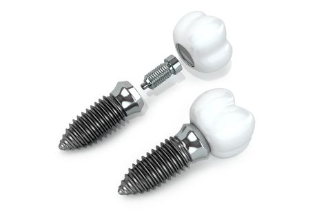 Dental and orthopedic implants